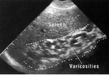 multiple vericosites in patients with portal hepatic schistosomiasis