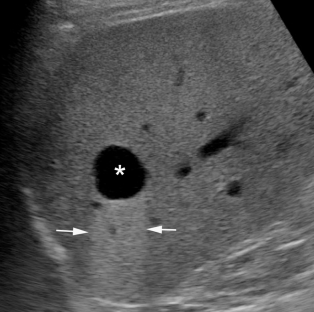 simple hepatic cyst