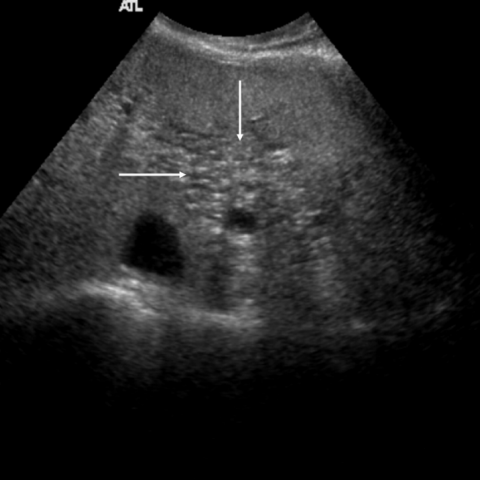 peribiliary cysts