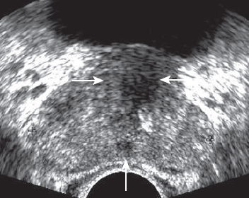 Prostate