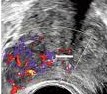 Prostate cancer