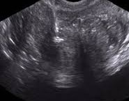 Prostate calcifications