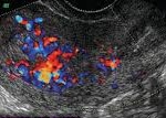 Endometrial cancer