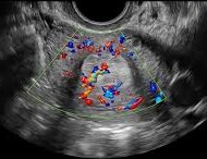 Endometrial polyp