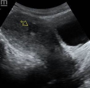 Uterine fibroid