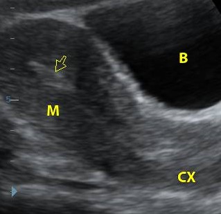 Uterus ultrasound