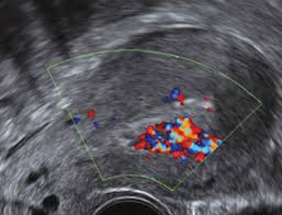 Retained products of conception