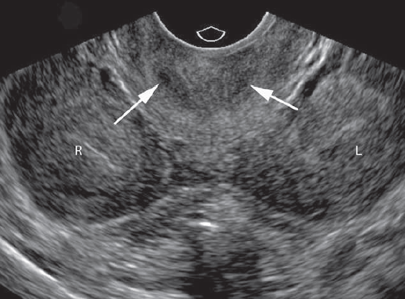 Uterus didelphys